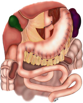 Gastric Bypass, Roux en-Y