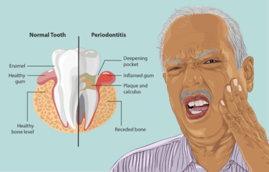 Depiction of a Periodontitis patient