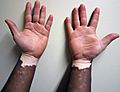 Vitiligo1