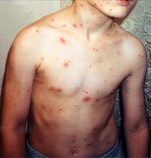 Child with chickenpox