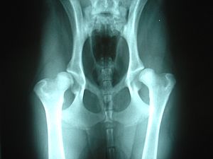 Bilateral hip dysplasia