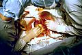 Coronary artery bypass surgery Image 657B-PH