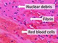 Composition of a fresh thrombus