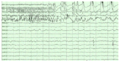 Epilepsy- right hippocampal seizure onset