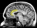 MRI anterior cingulate