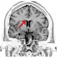 26638.medium-emphasizing-corpus-callosum