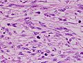 Histopathology of leiomyosarcoma