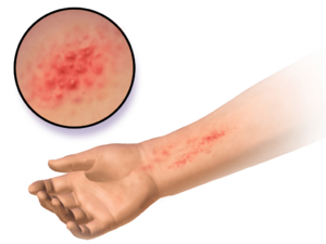 Blausen 0014 AllergicDermatitis