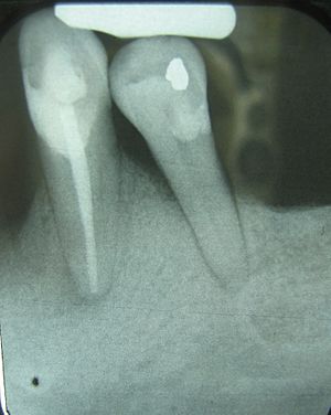 Periodontalboneloss