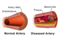 Blausen 0053 Artery NormalvsDiseasedVessel