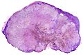 Lymph node with metastatic melanoma