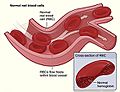 Modified sickle cell 01