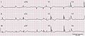 HypothermiaECG