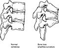 722 Feature Osteoprosis of Spine