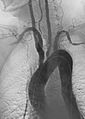 Takayasu Arteritis