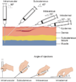 Needle-insertion-angles-1