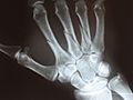 Metacarpal fractures