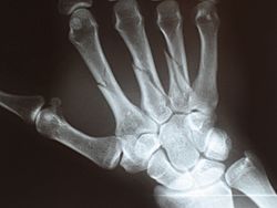 Metacarpal fractures.jpg