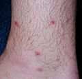 CercariaDermatitis