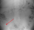 AppendicolithPlainXray