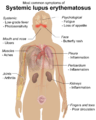 Symptoms of SLE