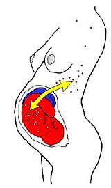 Microchimerism