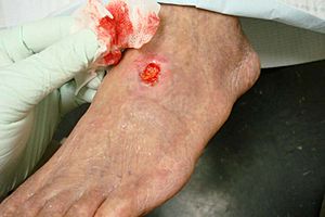 Arterial ulcer peripheral vascular disease