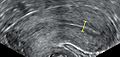 Triple-line endometrium