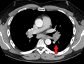 HilarAdenopathyCT