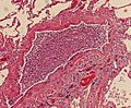 Histopathology of bronchopneumonia