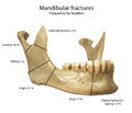 Mandbular fractures