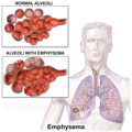 Blausen 0343 Emphysema