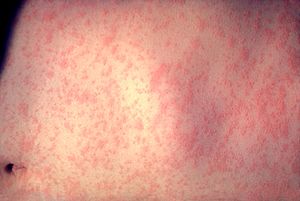 Morbillivirus measles infection