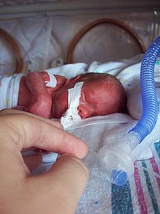 Premature infant with ventilator