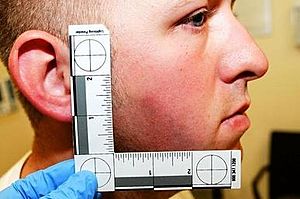 Darren wilson bruise