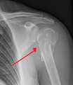 ProxHumeralFracture