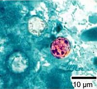 Cyclospora cayetanensis stained.jpg