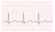 Tachycardia ECG paper.svg