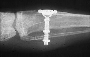 Branemark's initial radiograph