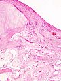 Primary osteoarthrosis (2) at knee joint