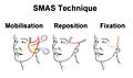 SMAS Facelift