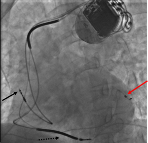 Cardiac resynchronisation therapy