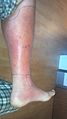 Cellulitis Of The Leg