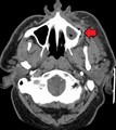 Dental infectionMark