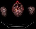 PET-CT scan of nasopharyngeal cancer