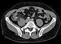 X-ray showing fecalith which has caused appendicitis