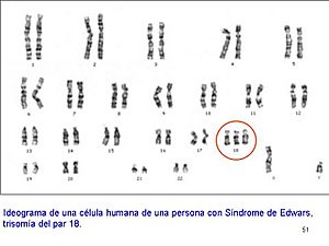 Trisomia 18