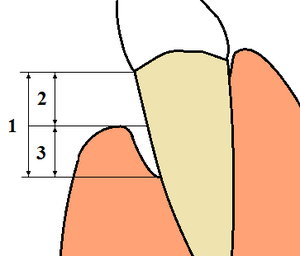 Periodontal terms diagram gingival recession