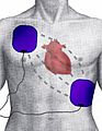 Defibrillation Electrode Position