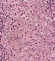 Lymphoepithelioma met to LN 2